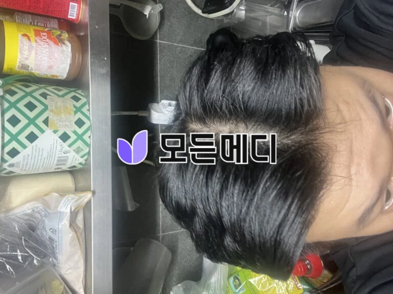 3년째 복용중입니다.
복용계획이 있으시다면 최초에 병원가서 프로페시아 처방 받아서 드셔보시고 부작용 없으시면 핀페시아로 넘어오시면 됩니다.
3년전 정수리부분부터 탈모가 생기고 m자 탈모도 같이 오면서 스트레스가 극에 달했는데 지금은 풍성한 모발로 살아가고 있습니다.