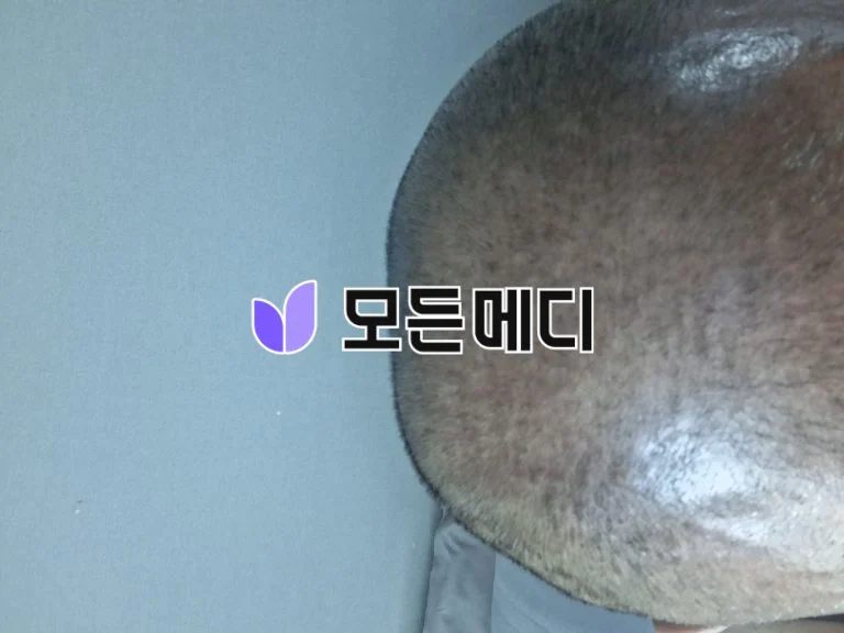 힐페시아 직구, 구매, 후기